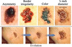 اشکال مختلف سرطان پوست