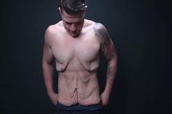 بعد از کاهش وزن پوستتان شل و زشت شده؟