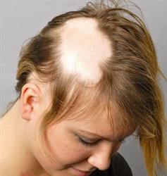 نکات مورد توجه در درمان ریزش موی منطقه ای (آلوپسی آره آتا)